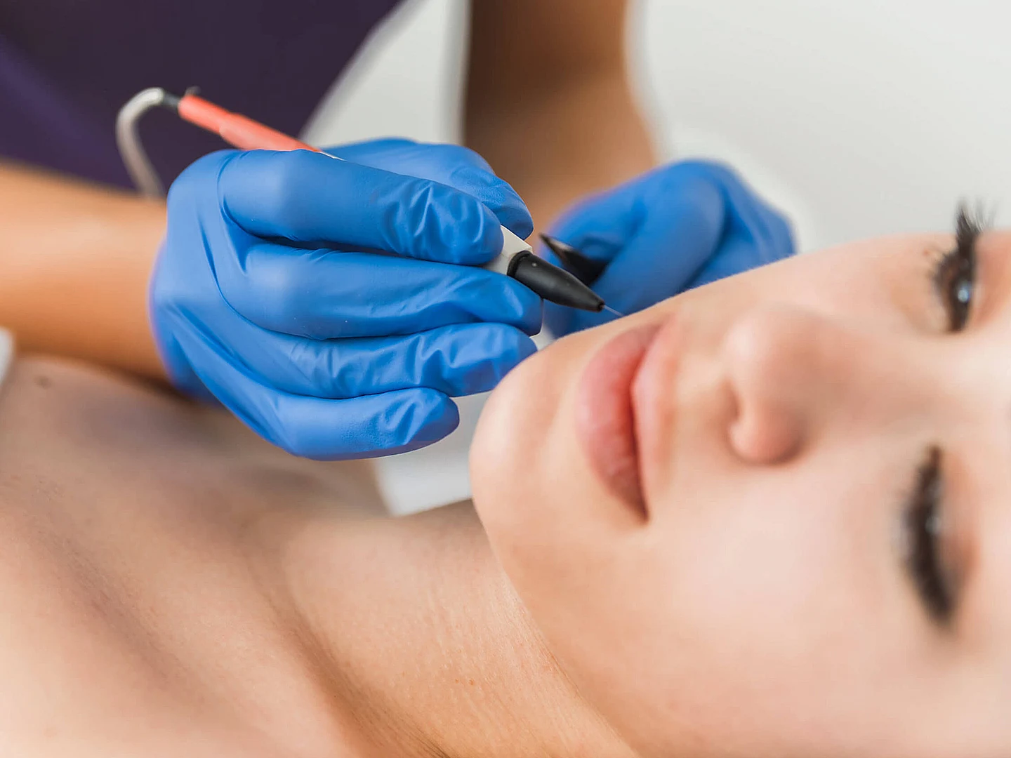 Blemish Removal with Advanced Electrolysis